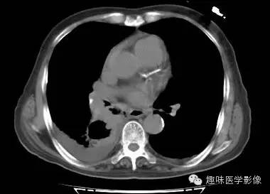 【病例】肺脓肿1例CT影像特点
