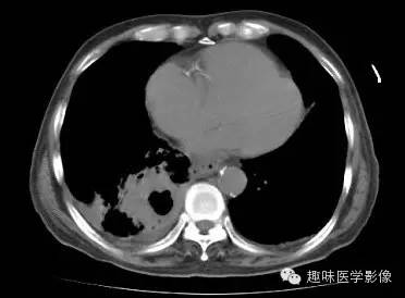 【病例】肺脓肿1例CT影像特点