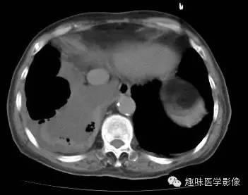 【病例】肺脓肿1例CT影像特点