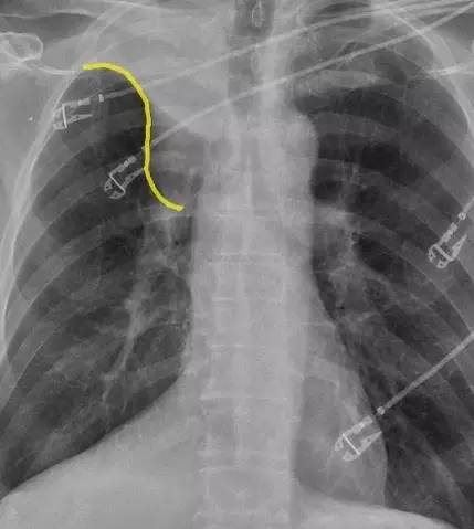 「反 S」征——肺部肿瘤的危险标志