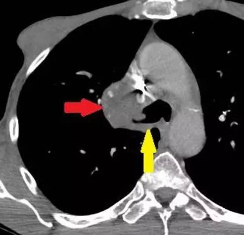 「反 S」征——肺部肿瘤的危险标志