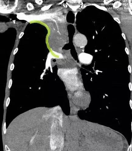 「反 S」征——肺部肿瘤的危险标志