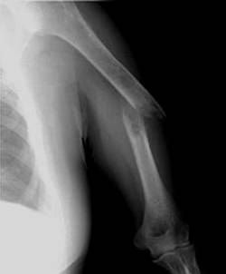 100张典型X线图片