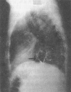 100张典型X线图片