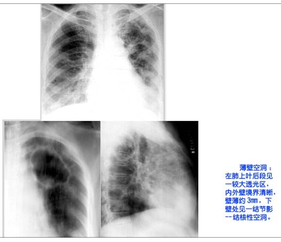 100张典型X线图片