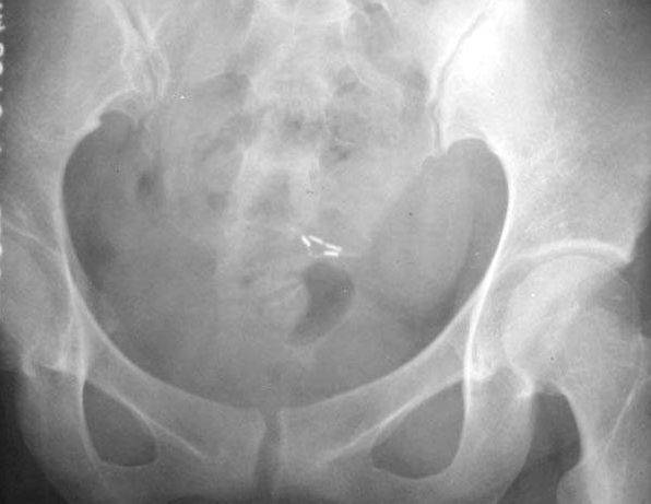 100张典型X线图片