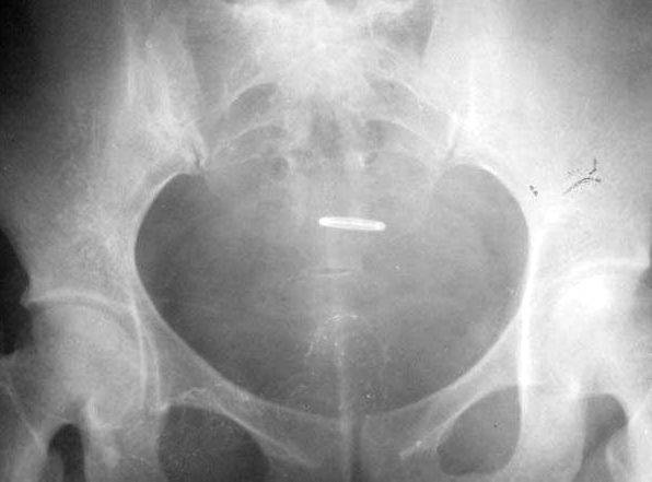 100张典型X线图片