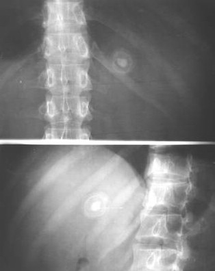 100张典型X线图片