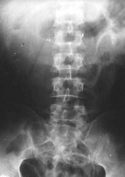 100张典型X线图片