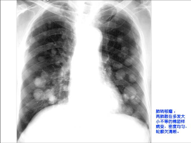 100张典型X线图片