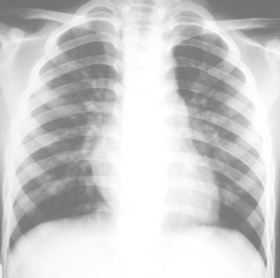 100张典型X线图片