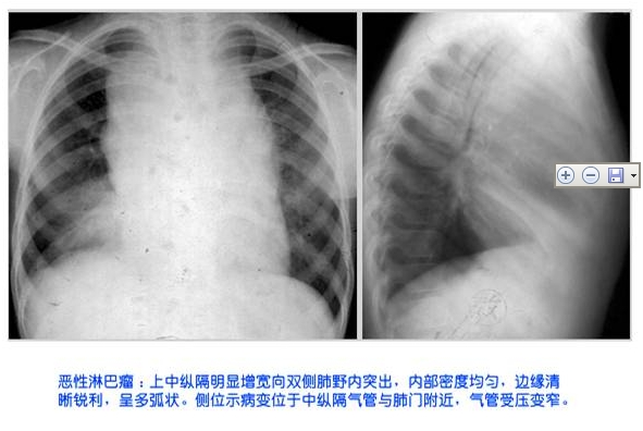 100张典型X线图片