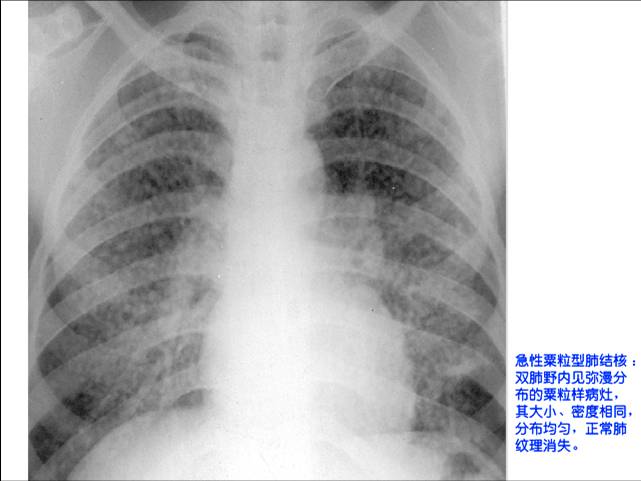 100张典型X线图片
