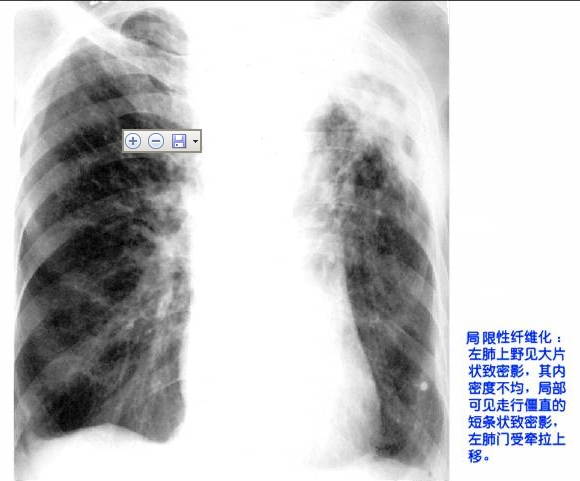 100张典型X线图片