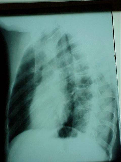 100张典型X线图片