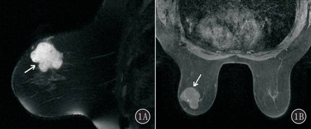 乳腺单纯型黏液腺癌的MRI表现 乳腺单纯型黏液腺癌的MRI表现