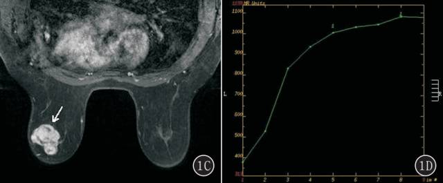 乳腺单纯型黏液腺癌的MRI表现 乳腺单纯型黏液腺癌的MRI表现