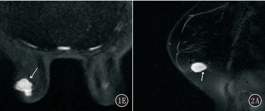 乳腺单纯型黏液腺癌的MRI表现 乳腺单纯型黏液腺癌的MRI表现