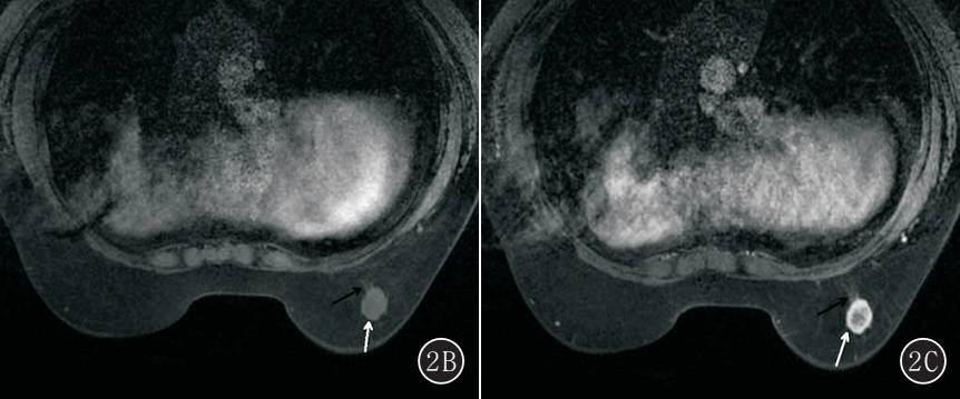 乳腺单纯型黏液腺癌的MRI表现 乳腺单纯型黏液腺癌的MRI表现