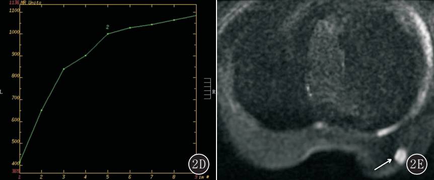 乳腺单纯型黏液腺癌的MRI表现 乳腺单纯型黏液腺癌的MRI表现