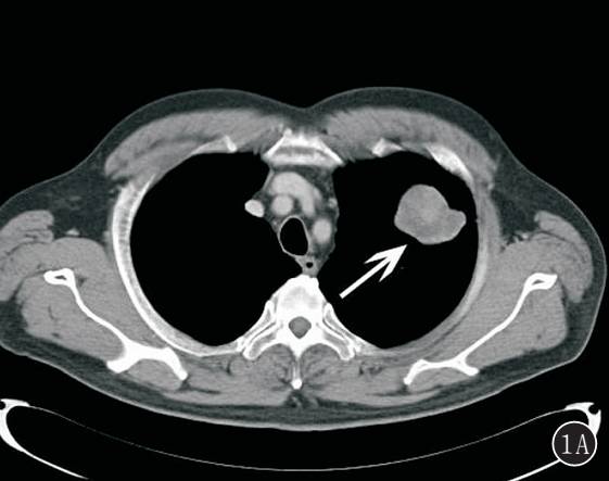 原发性肺肉瘤的CT诊断及鉴别诊断