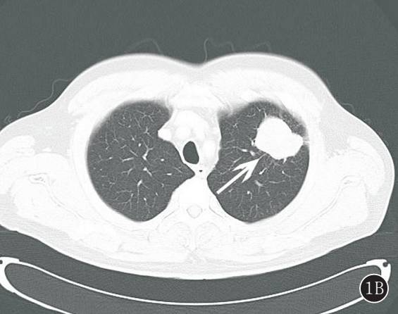 原发性肺肉瘤的CT诊断及鉴别诊断