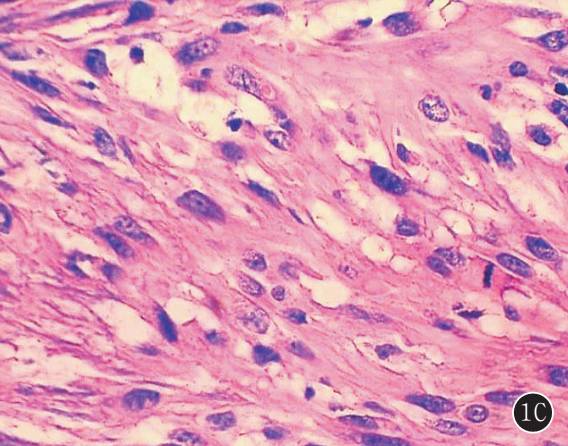 原发性肺肉瘤的CT诊断及鉴别诊断