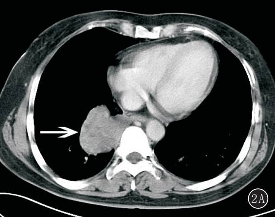 原发性肺肉瘤的CT诊断及鉴别诊断