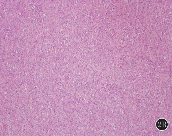 原发性肺肉瘤的CT诊断及鉴别诊断