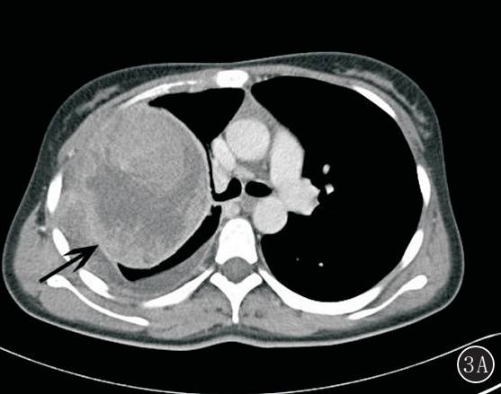 原发性肺肉瘤的CT诊断及鉴别诊断