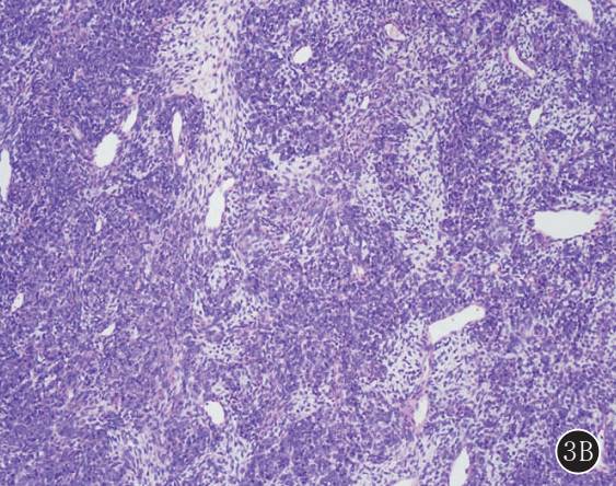 原发性肺肉瘤的CT诊断及鉴别诊断