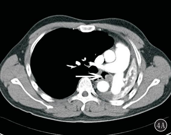 原发性肺肉瘤的CT诊断及鉴别诊断