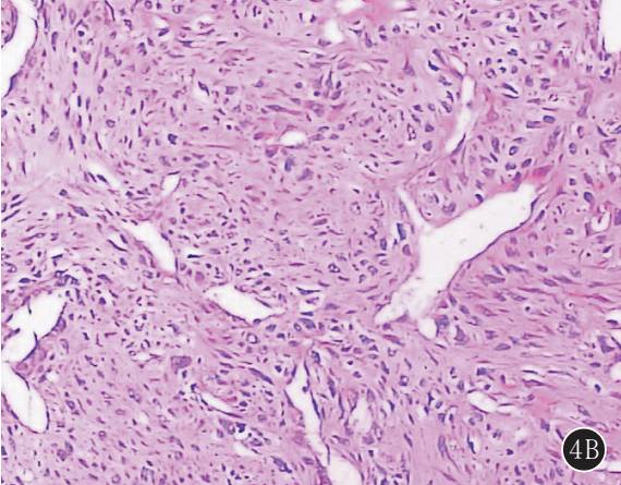 原发性肺肉瘤的CT诊断及鉴别诊断