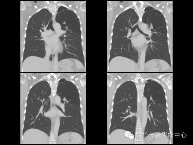 【病例】先天性支气管闭锁1例CT影像表现