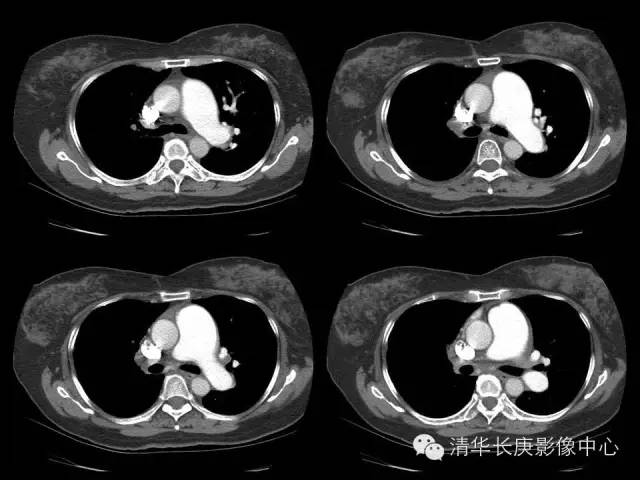 【病例】先天性单侧肺动脉缺如1例CT影像表现