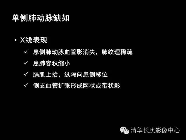 【病例】先天性单侧肺动脉缺如1例CT影像表现