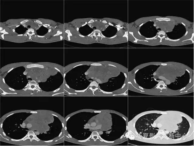 【病例】纵隔生殖细胞肿瘤1例CT影像表现
