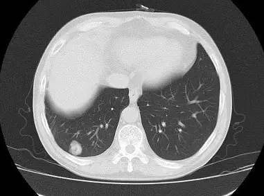【病例】肺错构瘤1例CT影像表现