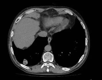 【病例】肺错构瘤1例CT影像表现
