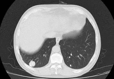 【病例】肺错构瘤1例CT影像表现
