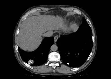 【病例】肺错构瘤1例CT影像表现