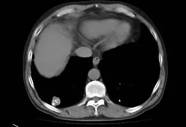 【病例】肺错构瘤1例CT影像表现