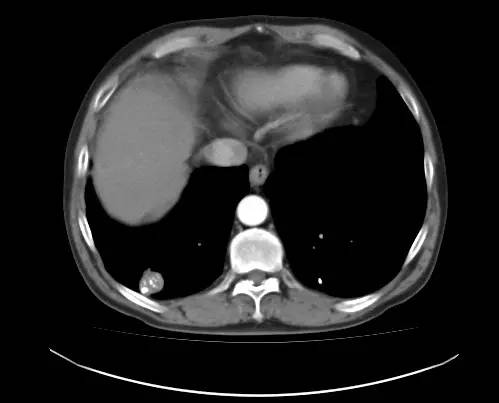【病例】肺错构瘤1例CT影像表现