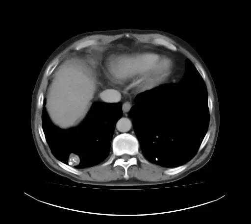 【病例】肺错构瘤1例CT影像表现