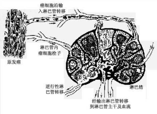 癌性淋巴管炎的发生机制及CT诊断