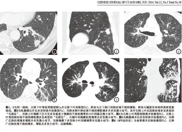 癌性淋巴管炎的发生机制及CT诊断