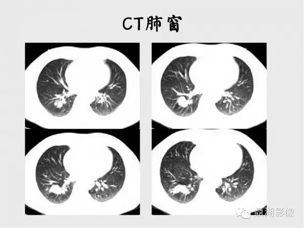 【病例】肺硬化性血管瘤1例CT影像表现与鉴别