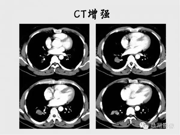 【病例】肺硬化性血管瘤1例CT影像表现与鉴别