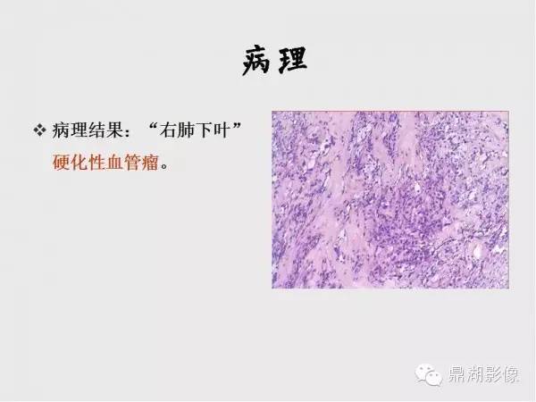 【病例】肺硬化性血管瘤1例CT影像表现与鉴别