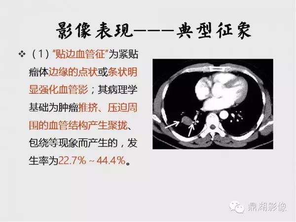 【病例】肺硬化性血管瘤1例CT影像表现与鉴别